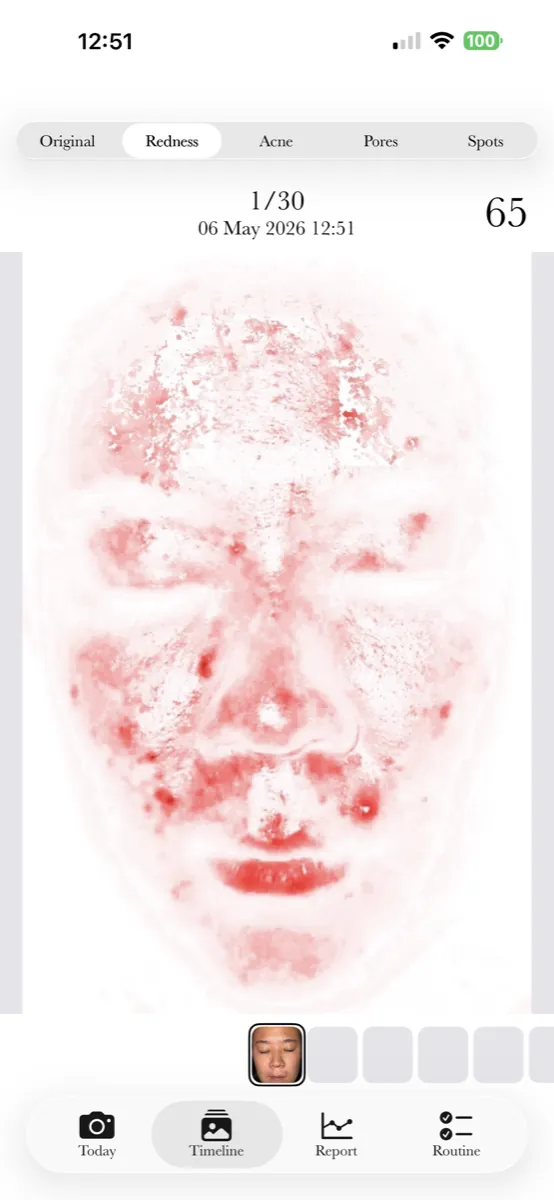 AI redness heatmap overlay