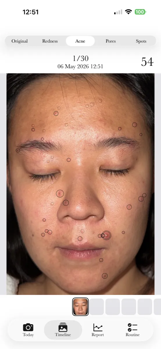 AI detects each acne lesion on your face